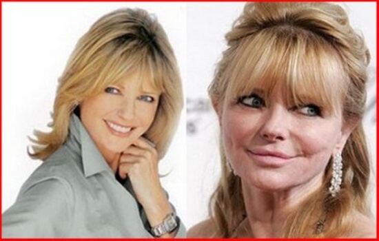 Cheryl Tiegs before and after picture