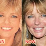Cheryl Tiegs before and after plastic procedures 150x150