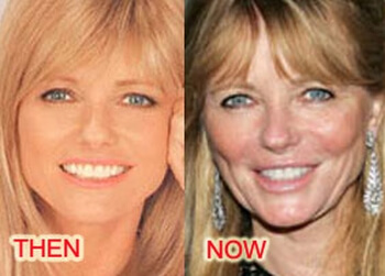 Cheryl Tiegs before and after plastic procedures