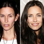 Courtney Cox before and after plastic surgery 150x150