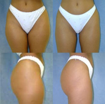 Liposuction procedure before and after