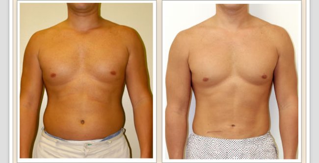 Man Liposuction before and after