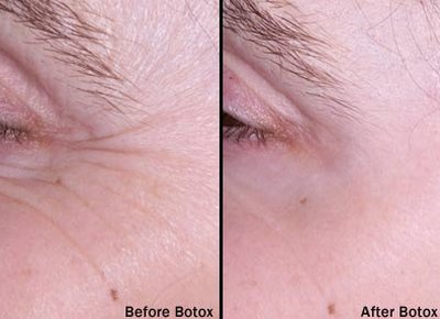 before and after botox treatment