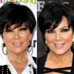 Kris Jenner before and after plastic surgery 150x150