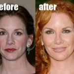 Melissa Gilbert before and after plastic surgeries 150x150