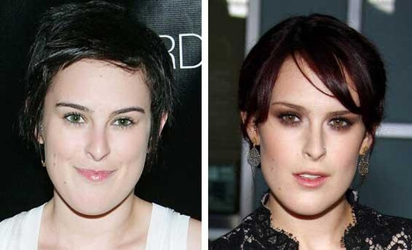 Rumer Willis before and after chin surgery