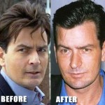 Charlie Sheen before after surgery 150x150
