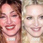 Madonna plastic surgery before after 150x150
