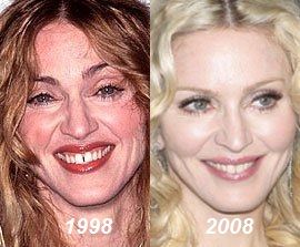 Madonna plastic surgery before after
