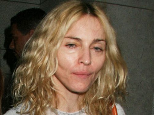 Madonna plastic surgery photo