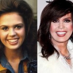 Marie Osmond before and after cosmetic surgery 150x150