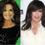 Marie Osmond before and after plastic surgery 150x150