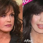Marie Osmond cosmetic plastic surgery before and after 150x150