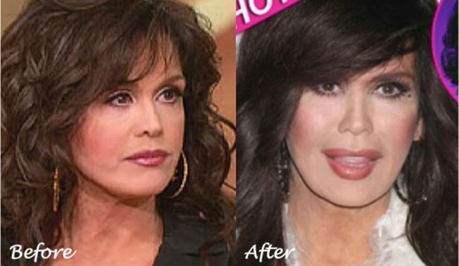Marie Osmond cosmetic plastic surgery before and after