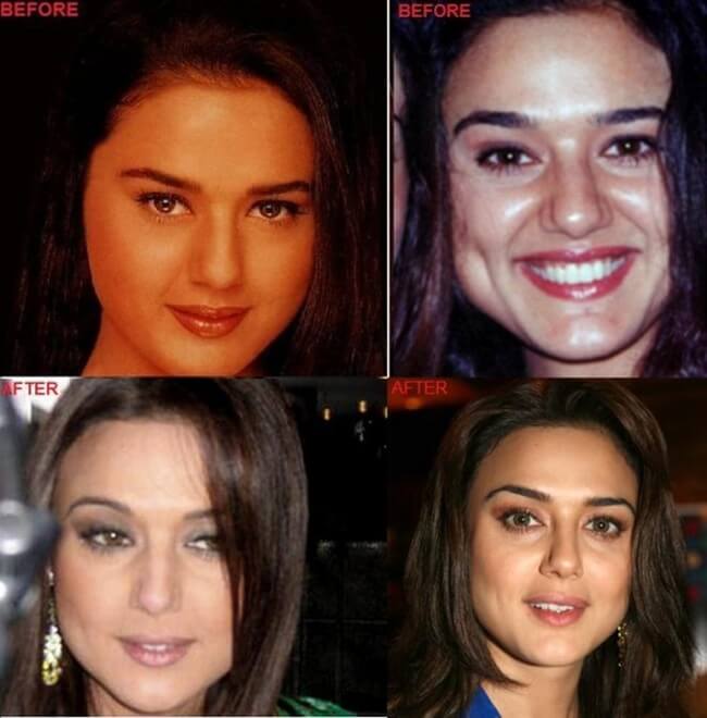 Preity Zinta before and after pictures