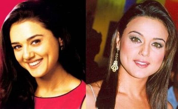 Preity Zinta before and after plastic surgery