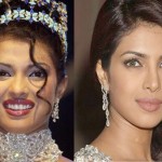 Priyanka Chopra before and after nose job 150x150
