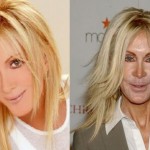 Joan Van Ark plastic surgery before and after 150x150