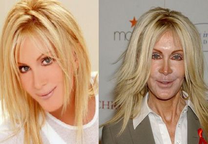 Joan Van Ark plastic surgery before and after