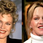 Melanie Griffith before and after 150x150