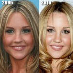 Amanda Bynes before and after surgery 150x150