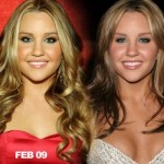 Amanda Bynes plastic surgery before and after 150x150