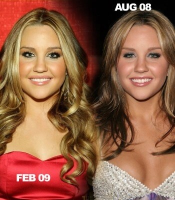 Amanda Bynes plastic surgery before and after