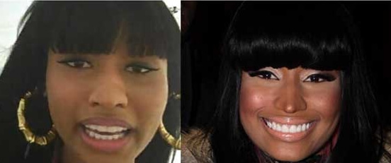 Nicki Minaj plastic surgery before