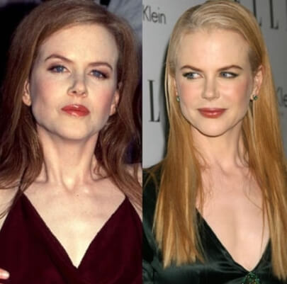 Nicole Kidman before and after plastic surgery
