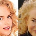 Nicole Kidman plastic surgery before after 150x150