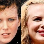 Nicole Kidman plastic surgery before and after 150x150