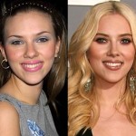 Scarlett Johansson before and after plastic surgery 150x150
