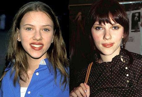 Scarlett Johansson plastic surgery before and after