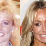 Taylor Armstrong after and before cosmetic procedures 150x150