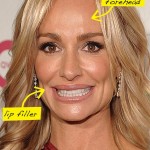 Taylor Armstrong plastic surgeries 150x150
