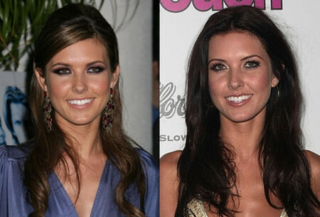 audrina patridge face after and before
