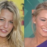 Blake Lively plastic surgery before after 150x150