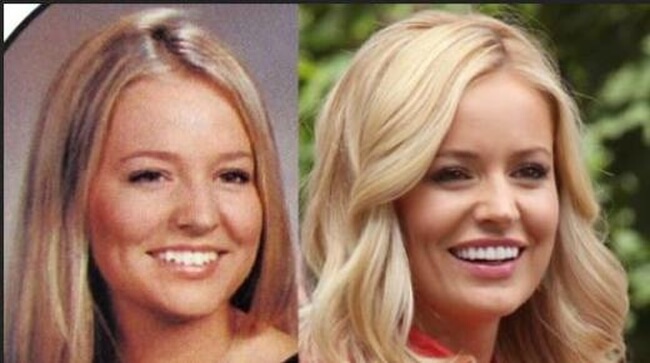Emily Maynard before and after plastic surgery