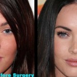 Megan Fox before and after plastic surgery 150x150