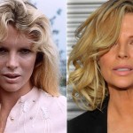 Kim Basinger before and after cosmetic procedures 150x150