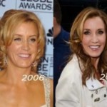 Felicity Huffman before and after plastic surgery 150x150
