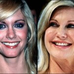 Olivia Newton John before and after 150x150