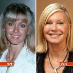 Olivia Newton John before and after cosmetic procedures 150x150