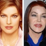 Priscilla Presley before and after plastic surgery 150x150