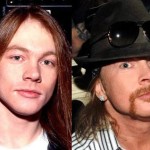 axl rose before and after plastic procedures 150x150