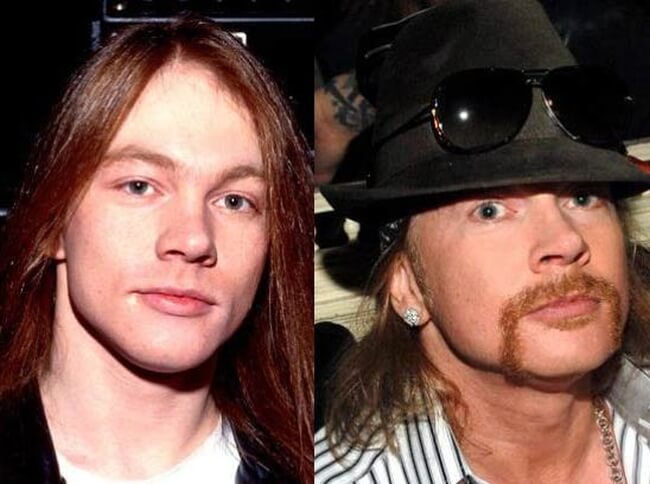 axl rose before and after plastic procedures
