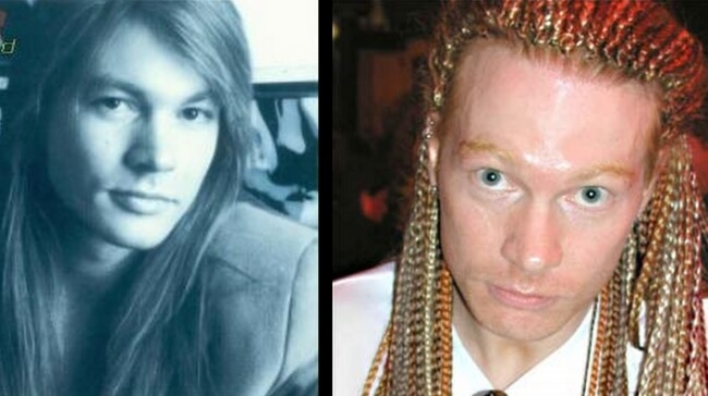 axl rose before and after plastic surgery