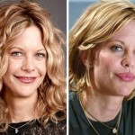 Meg Ryan before and after botox and lip implants 150x150