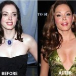 Rose McGowan plastic surgery before and after 150x150