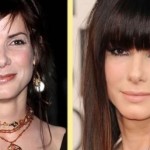 Sandra Bullock before and after plastic surgery procedures 150x150